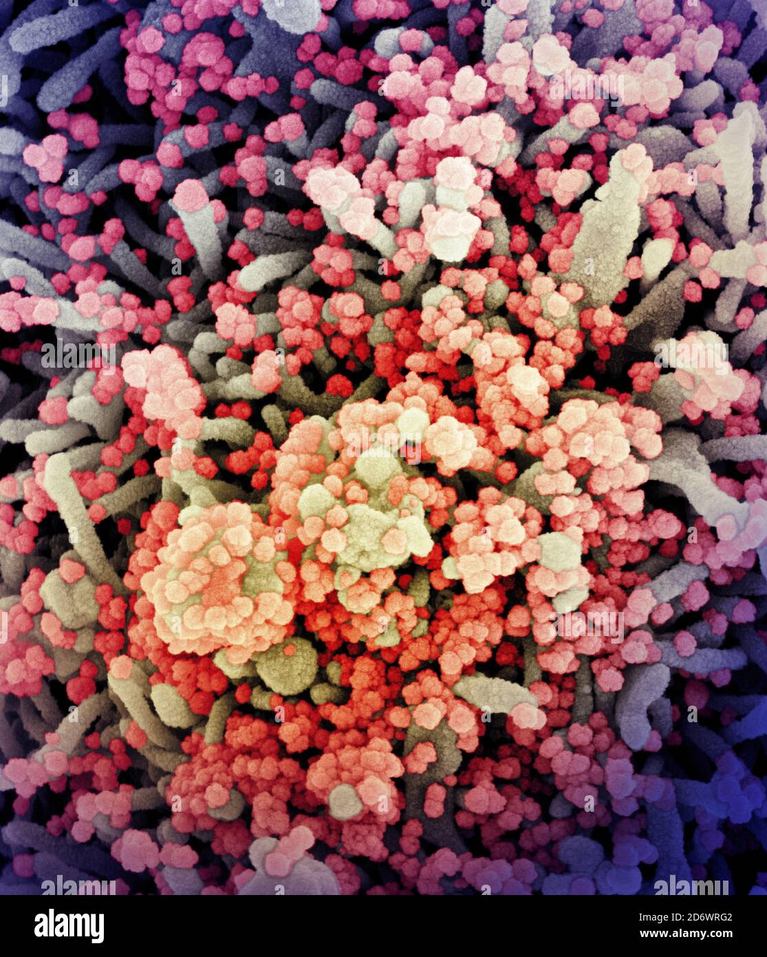 Eingefärbtes Rasterelektronenmikrograph einer Zelle, die stark mit SARS-CoV-2-Viruspartikeln (orange/rot) infiziert ist und aus einer Patientenprobe isoliert ist. Bild Stockfoto