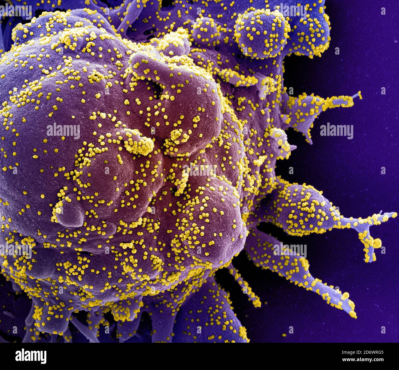 Koloriertes Rasterelektronenmikrograph einer apoptotischen Zelle (violett), die stark mit SARS-COV-2-Viruspartikeln (gelb) infiziert ist und von einem Patienten isoliert ist Stockfoto