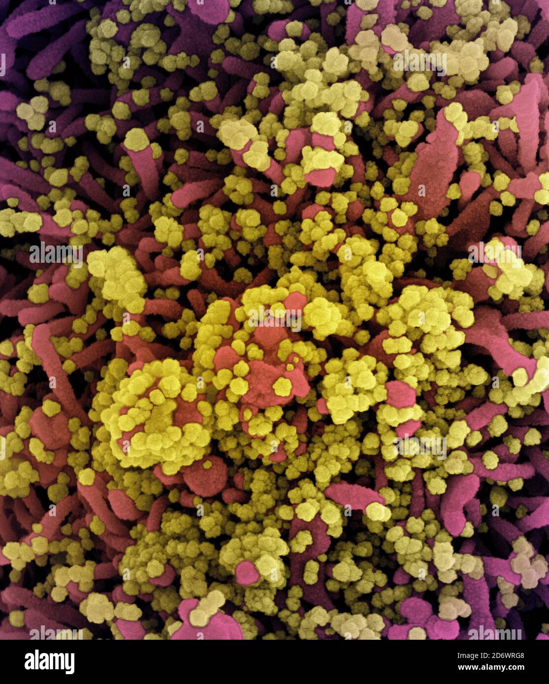 Koloriertes Rasterelektronenmikrograph einer Zelle, die stark mit SARS-CoV-2-Viruspartikeln (gelb) infiziert ist und aus einer Patientenprobe isoliert wurde. bildunterz Stockfoto