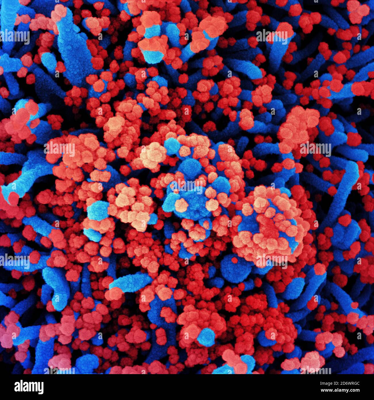 Eingefärbtes Rasterelektronenmikrograph einer Zelle (blau), die stark mit SARS-CoV-2-Viruspartikeln (rot) infiziert ist und aus einer Patientenprobe isoliert wurde. Bild Stockfoto