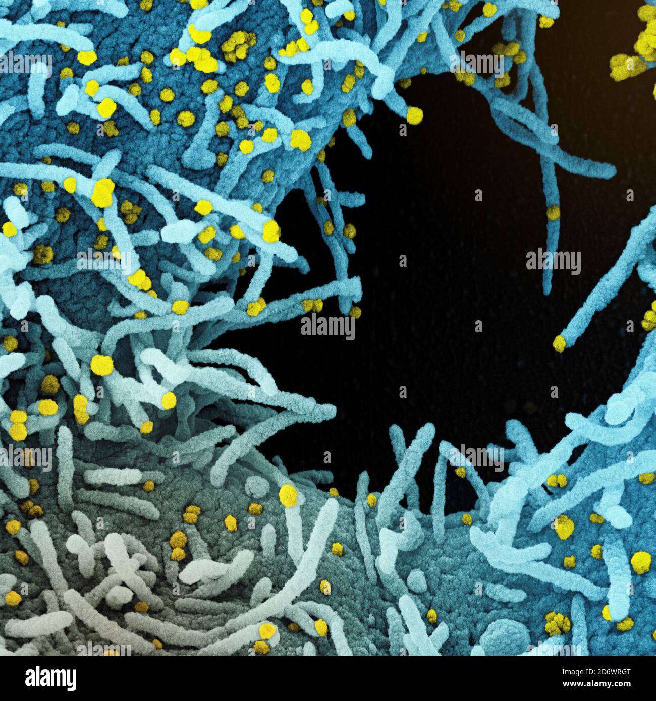 Koloriertes Rasterelektronenmikrograph einer Zelle, die stark mit SARS-CoV-2-Viruspartikeln (gelb) infiziert ist und aus einer Patientenprobe isoliert wurde. Das Schwarz Stockfoto