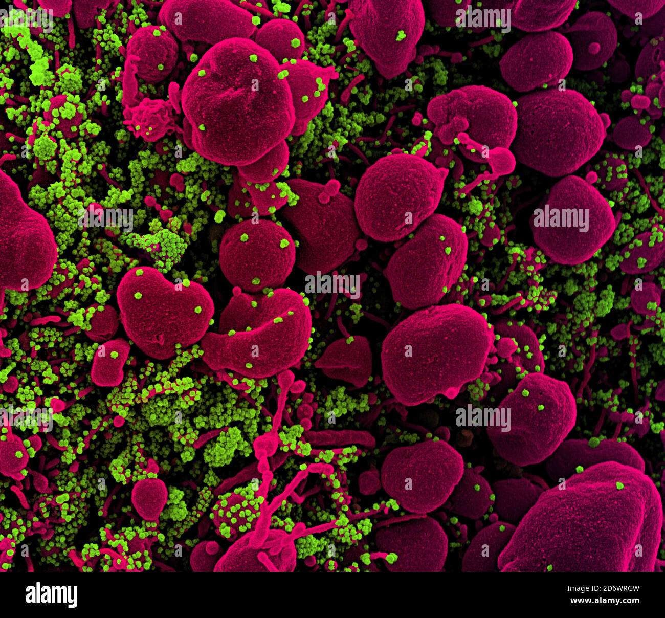 Koloriertes Rasterelektronenmikrograph einer apoptotischen Zelle (rosa), die stark mit SARS-COV-2-Viruspartikeln (grün) infiziert ist und von einem Patienten isoliert ist Stockfoto