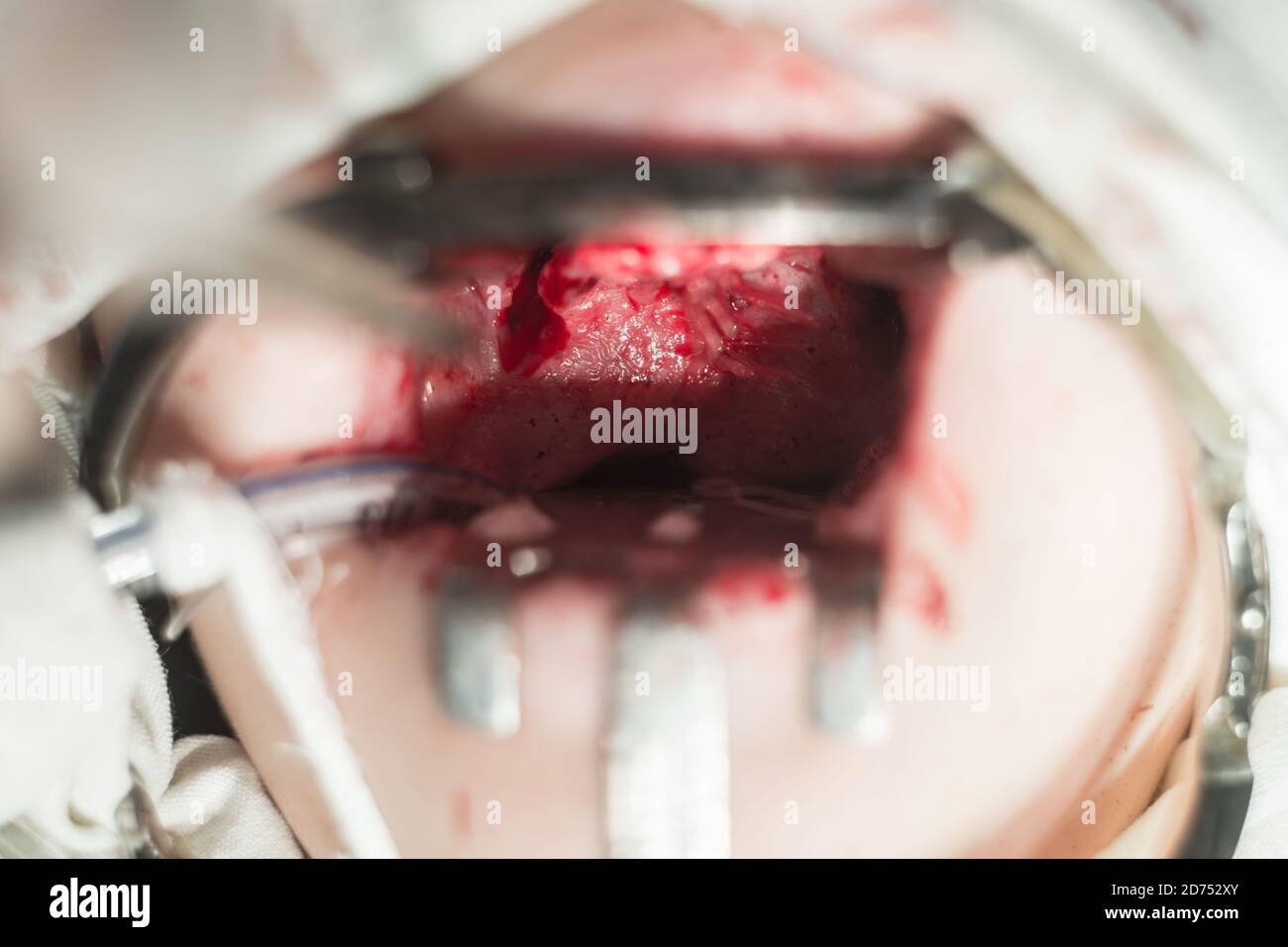 Eine der Stufen der Operation für Gaumenspalte bei Kindern. Mund offen mit konservativen, blutigen Wunden. Operative Zahnmedizin Stockfoto