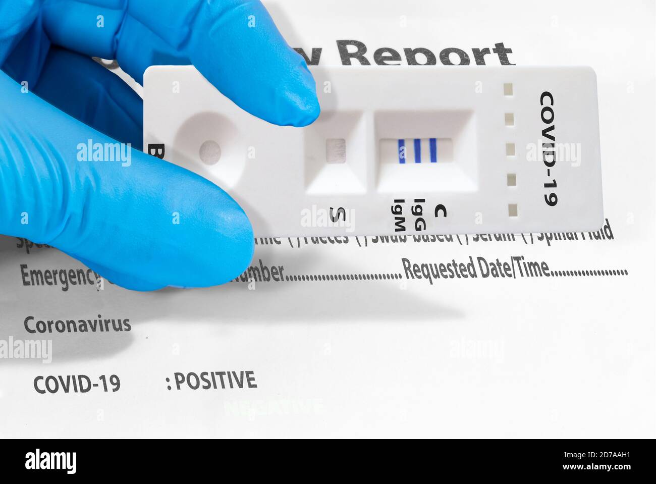 Die Hand eines Arztes oder eines Laboranten zeigt einen schnellen COVID-19-Labortest zum Nachweis von IgM- und IgG-Antikörpern gegen das neue Coronavirus SARS-CoV-2 wit Stockfoto
