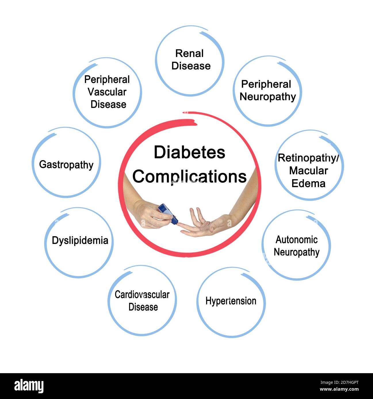 Acht Komplikationen von Diabetes Stockfoto