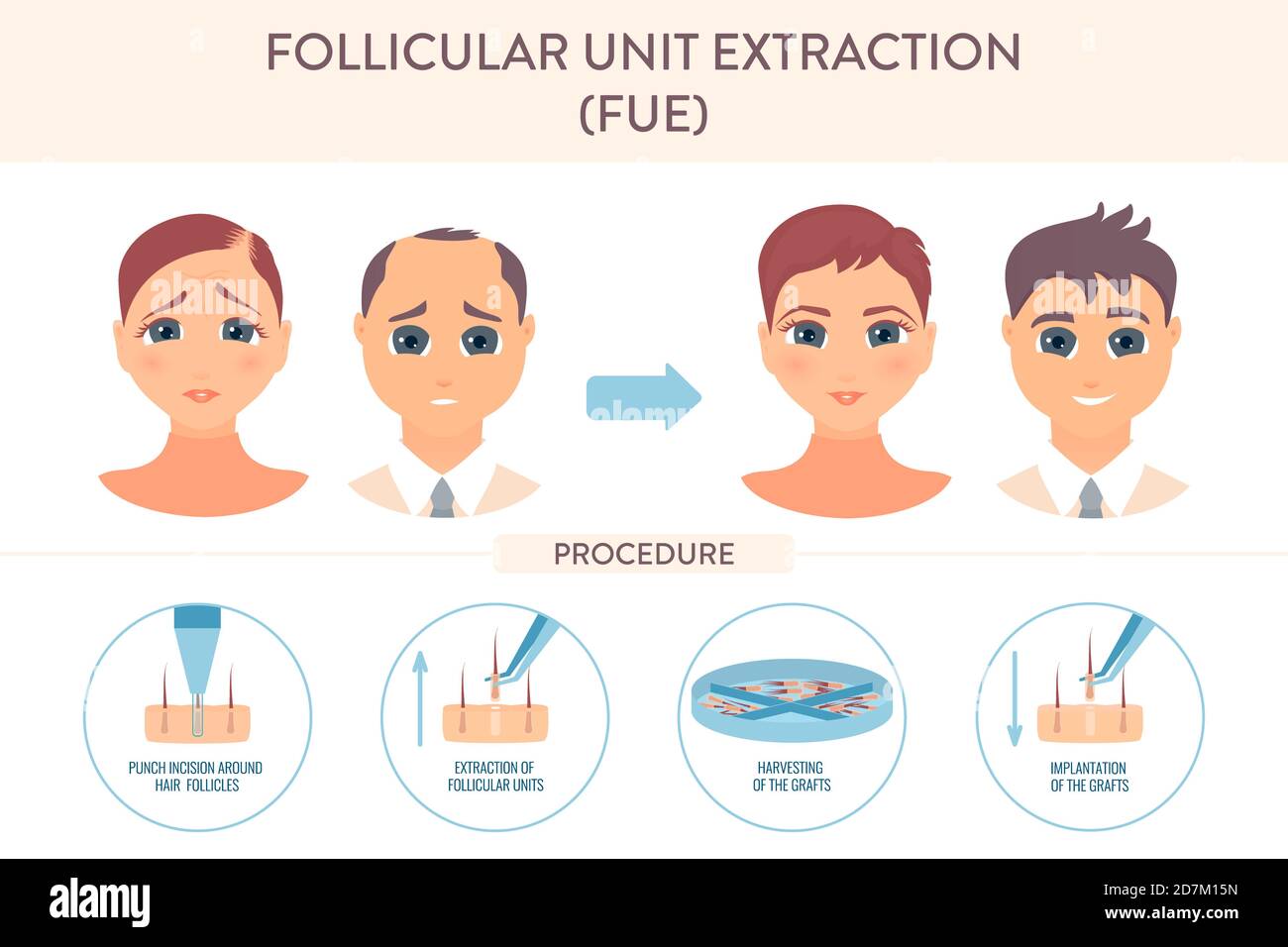 Follikuläre Extraktion (FuE) Chirurgie, konzeptionelle Illustration. Stockfoto