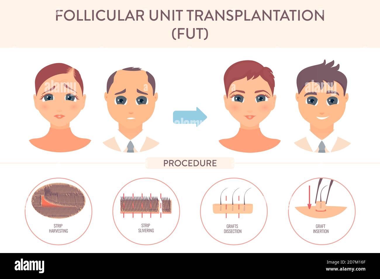 Follikuläre Unit Transplantation (FUT)Chirurgie, konzeptionelle Illustration. Stockfoto