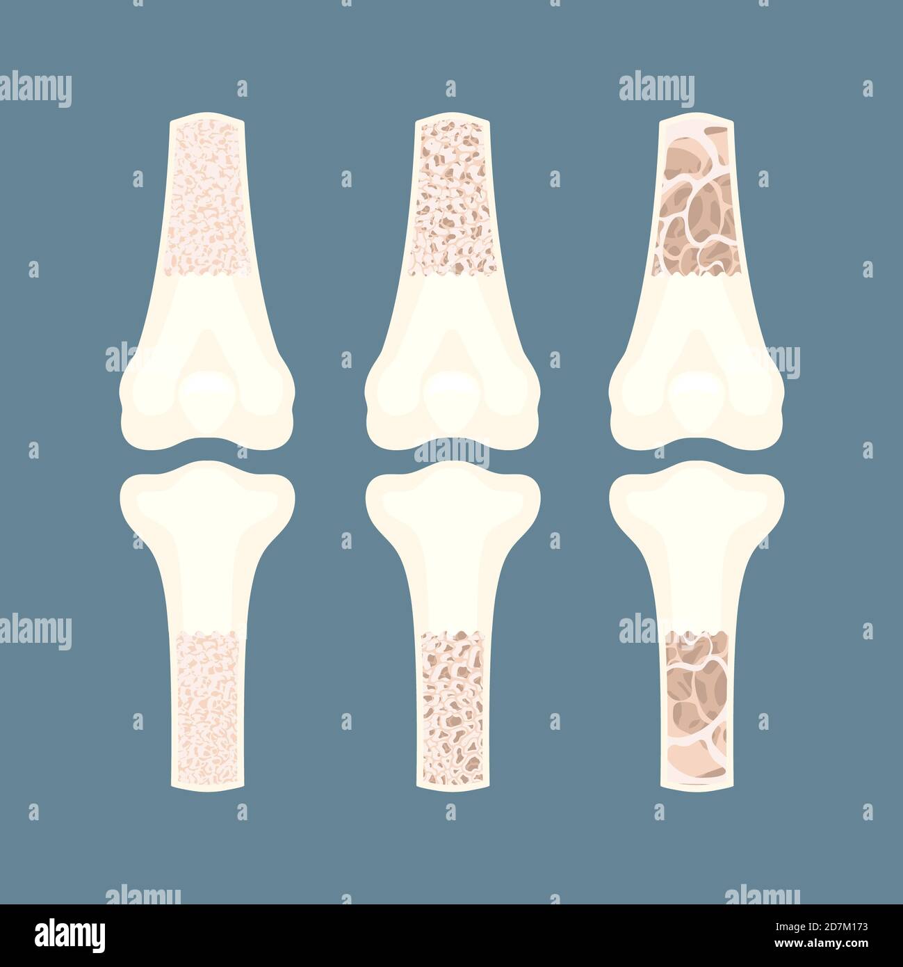 Osteoporose-Bewusstsein, konzeptionelle Illustration. Stockfoto