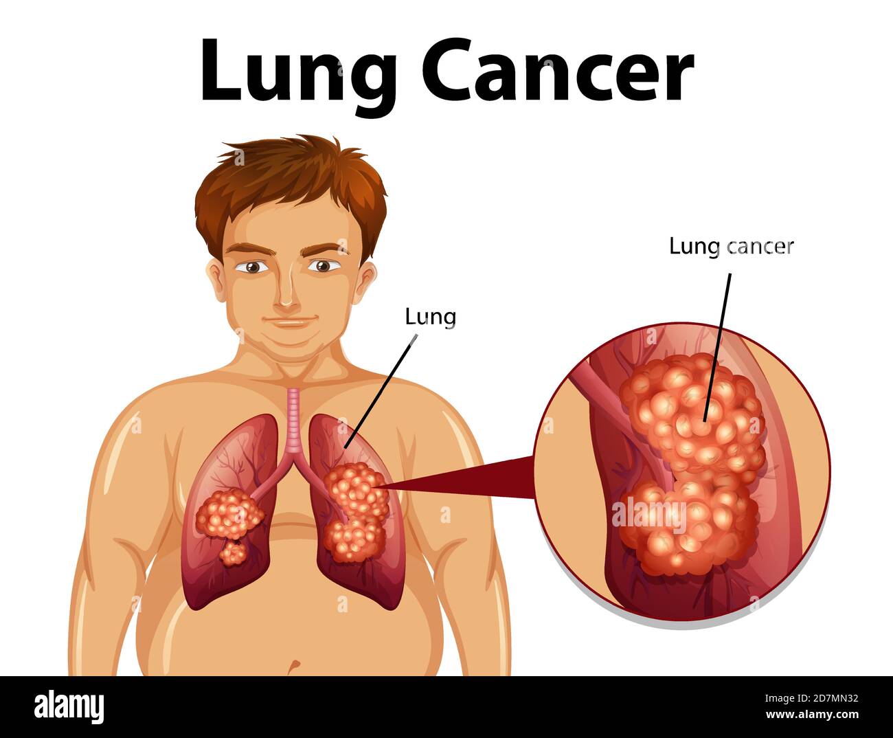 Informative Illustration von Lungenkrebs Illustration Stock Vektor