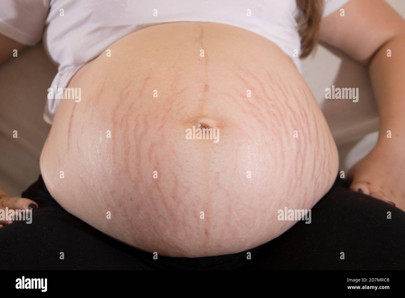 Bauch dehnungsstreifen Finden Sie
