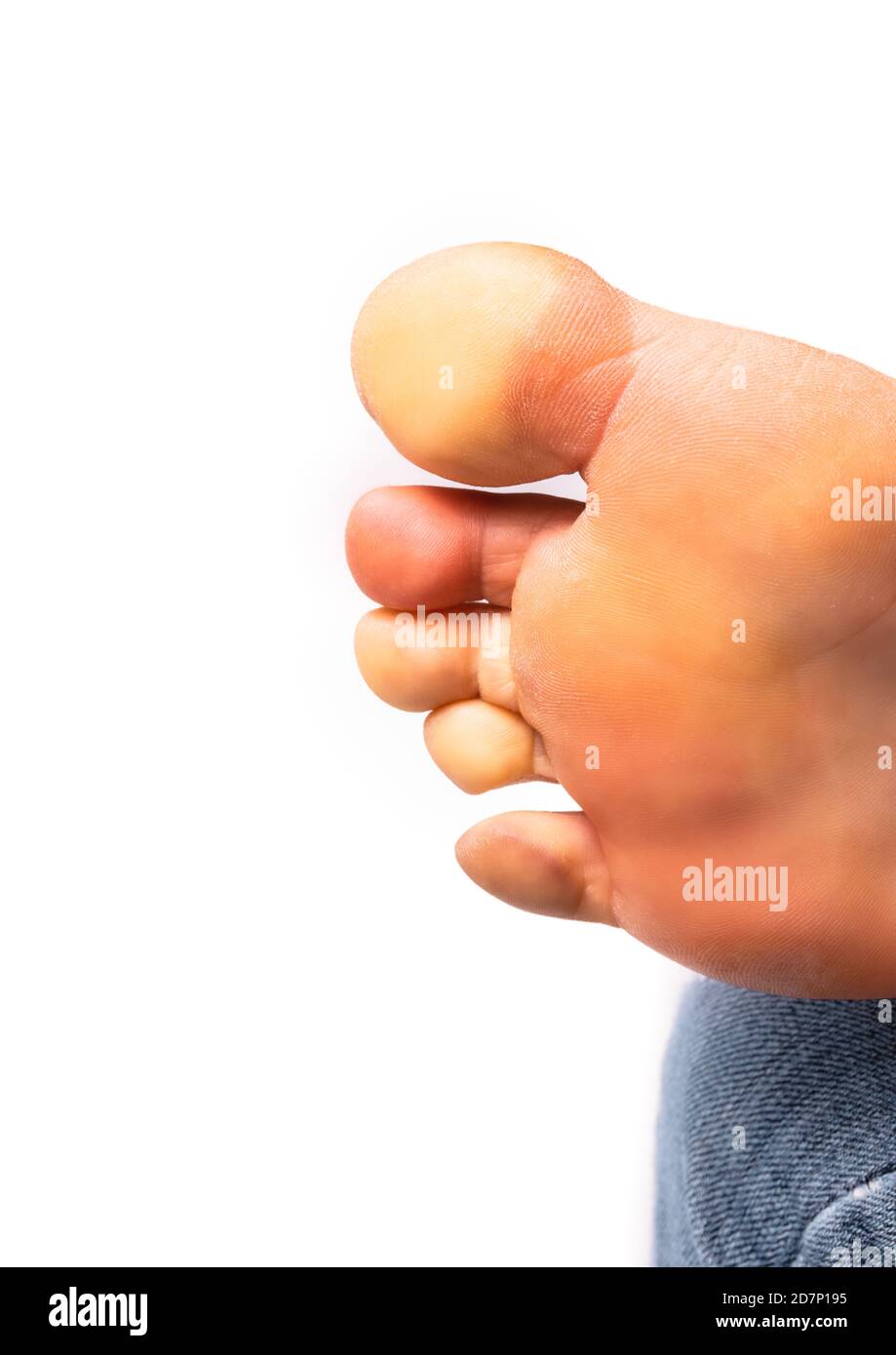 Weiblicher Fuß mit Raynaud-Syndrom, Raynaud-Phänomen oder Raynaud-Erkrankungen. Die Zehen wurden aufgrund des Mangels an Blutfluss weiß (Pallor). Stockfoto