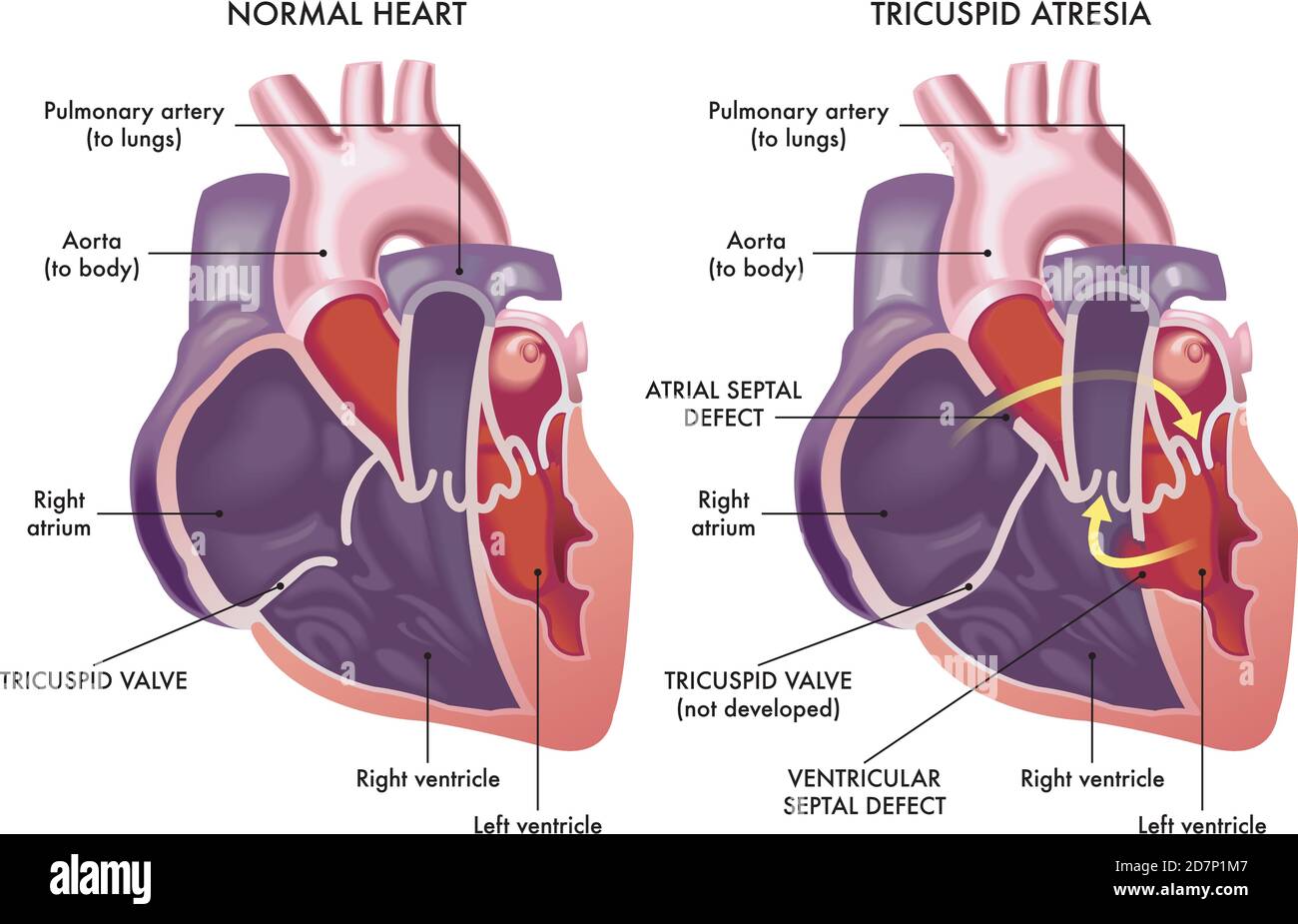 Medizinische Illustration, die ein normales Herz mit einem Herz vergleicht, das von einem Herzfehler namens Tricuspidatresie betroffen ist, mit Anmerkungen. Stock Vektor