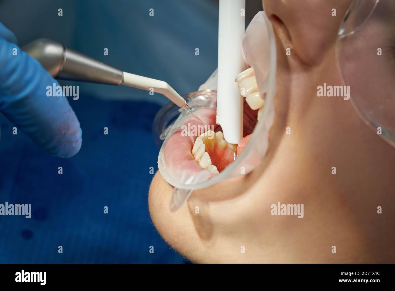 Zahnarzt mit Luft Wasser Spray während der Behandlung des Patienten  Stockfotografie - Alamy