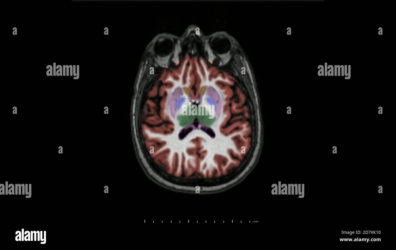 Magnetresonanztomographie des Gehirns in axialer Ebene farbcodierte Sequenz für die Diagnose von Gedächtnisstörungen und Alzheimer-Krankheit verwendet. MRT-Gehirn. Stockfoto