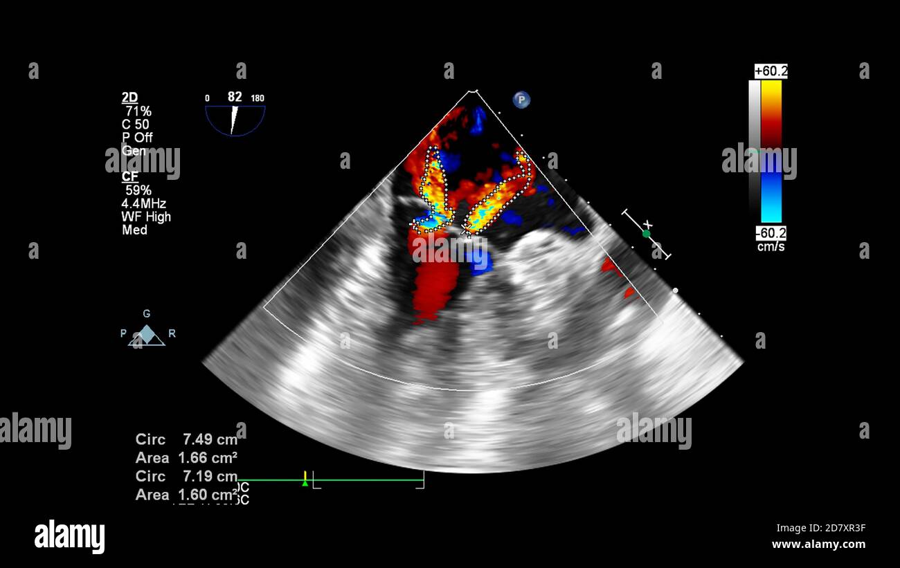 Bild des Herzens während des transösophagealen Ultraschalls mit Doppler-Modus. Stockfoto