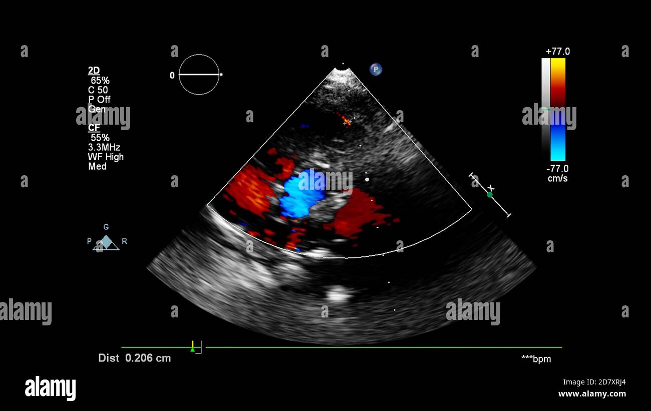Bild des Herzens während des transösophagealen Ultraschalls mit Doppler-Modus. Stockfoto