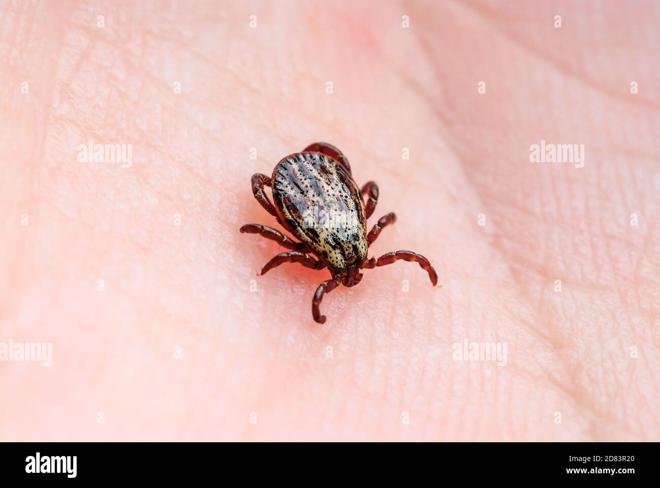Lyme-Borreliose infizierte Tick Mite Insekt kriechen auf der Haut. Enzephalitis Virus oder Lyme-Borreliose Infektiöse Dermacentor Tick Arachnid Parasiten Close-Up Stockfoto
