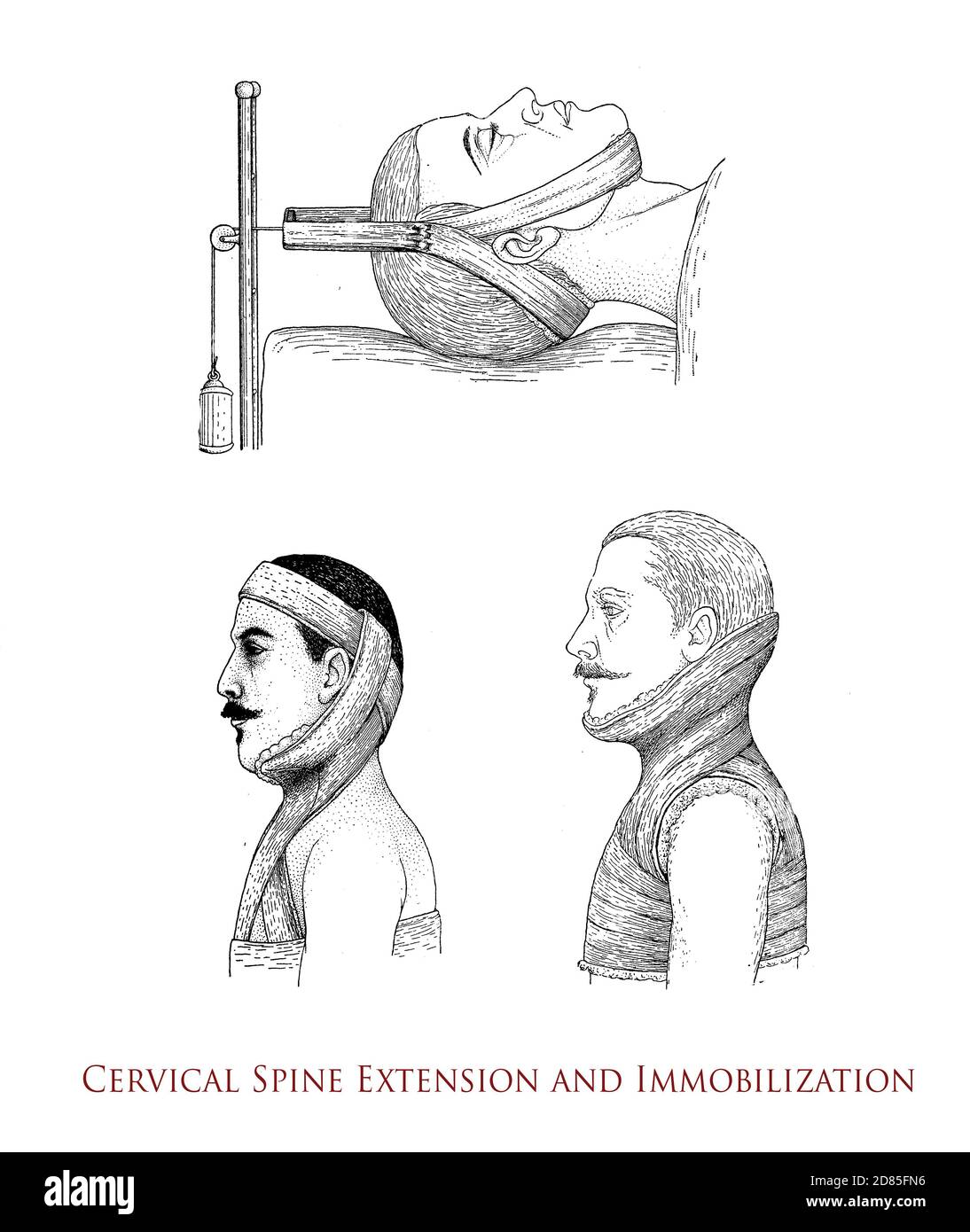 Healthcare und Medizin vintage Illustration: Halswirbelsäule Verlängerung und Immobilisierung mit einem starren Halsband Stockfoto