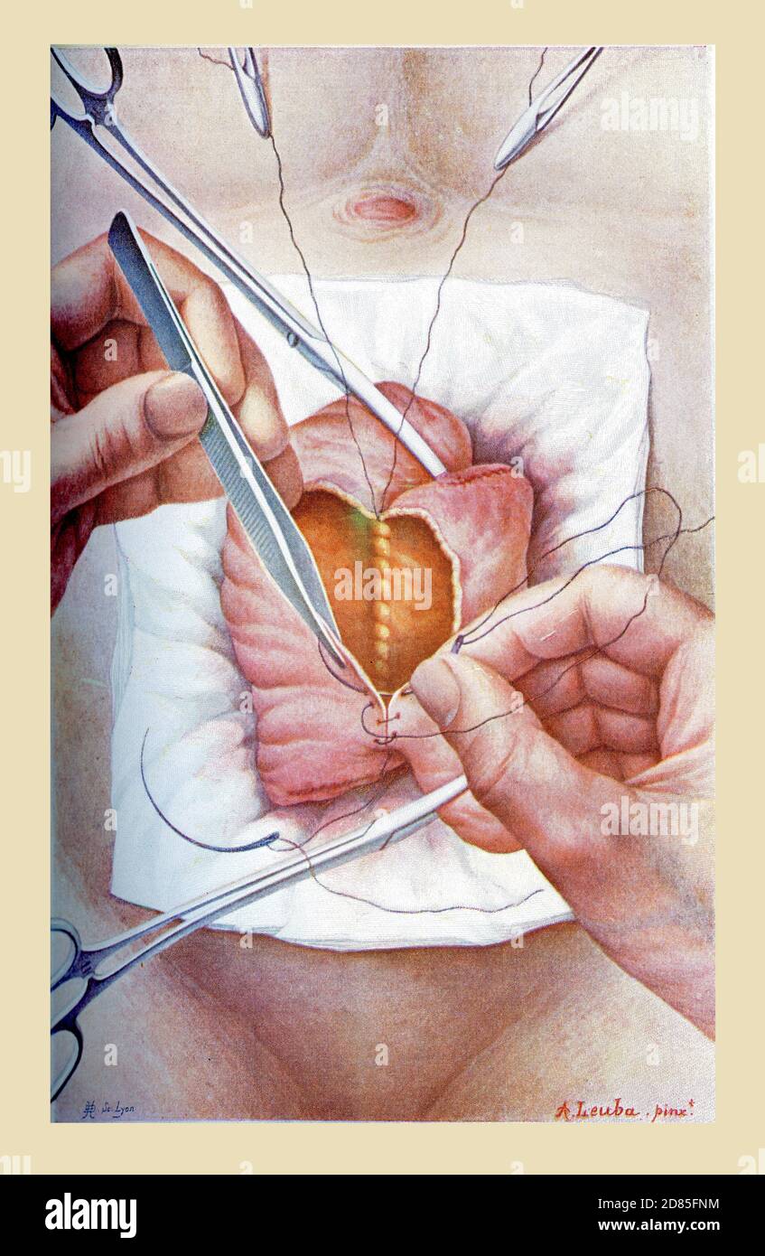 Healthcare und Medizin vintage Farbe Illustration: Enteroanastomose, chirurgische Einrichtung einer Kommunikation zwischen zwei entfernten Teilen des Darms Stockfoto
