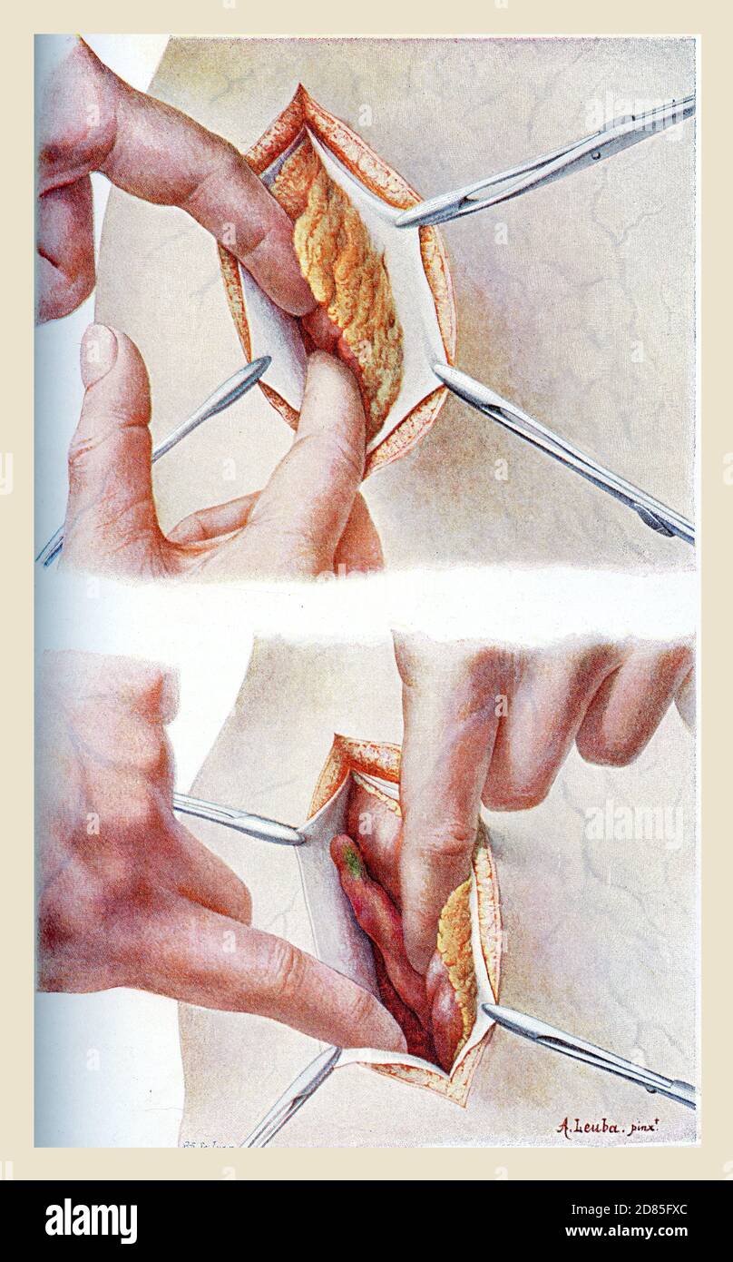Healthcare und Medicine vintage Farbe Illustration: Chirurgische Entfernung des Blinddarms mit einem offenen Schnitt in den Bauch (Laparotomie) Stockfoto