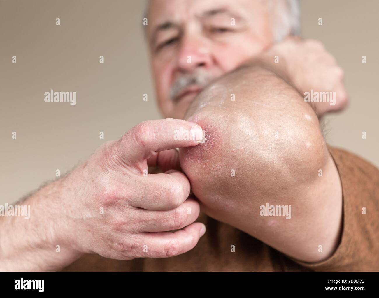 Schuppenflechte am Ellenbogen. Closeup Dermatitis auf der Haut krank allergischer Ausschlag Dermatitis Ekzem des Patienten atopische Dermatitis Symptom Haut Detail Textur, Fungu Stockfoto