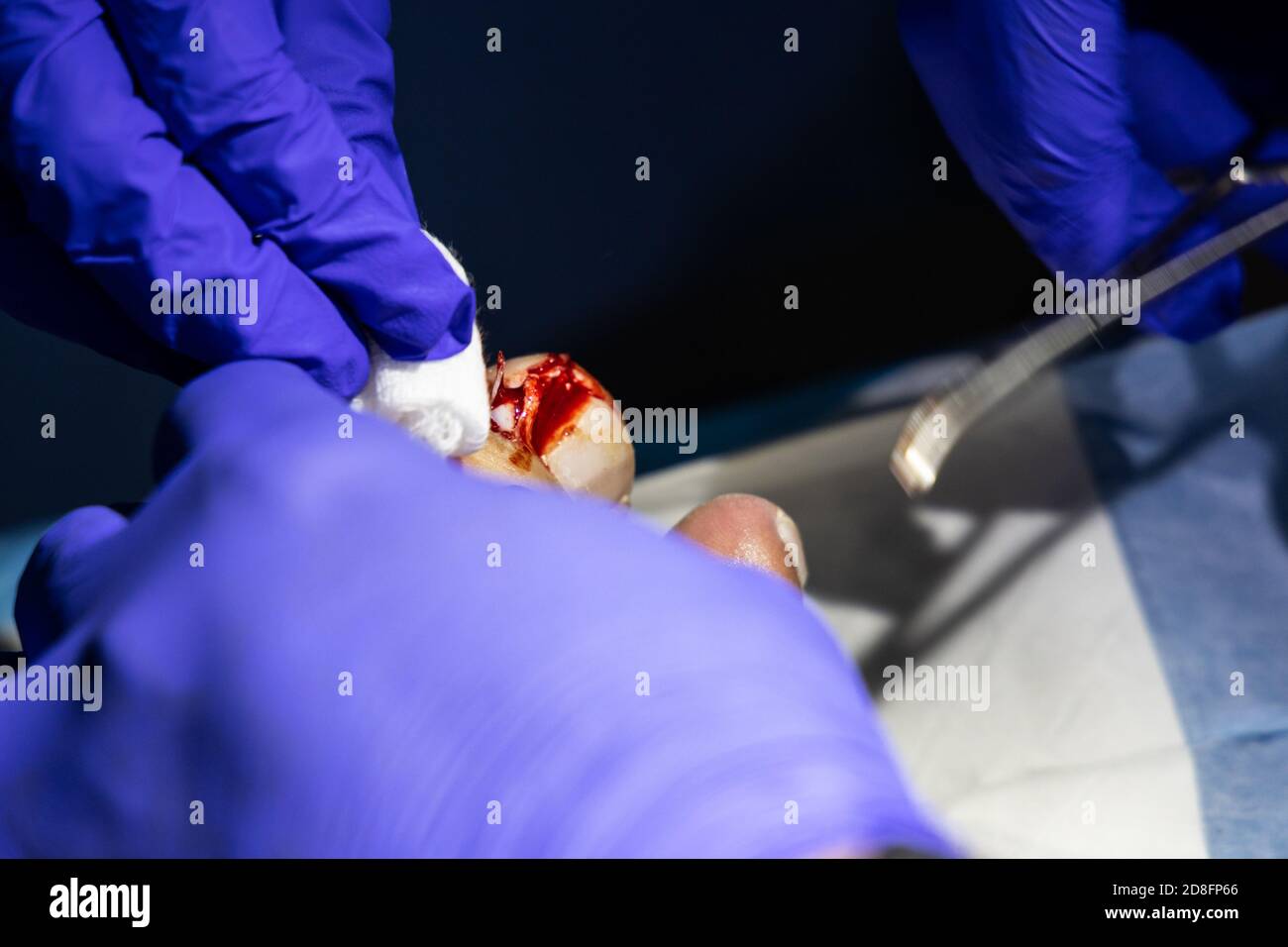 Serie der eingewachsenen Zehennagelbehandlung. Arzt schneiden und extrahieren Zehennagel-Infektion mit forcep Schere Stockfoto