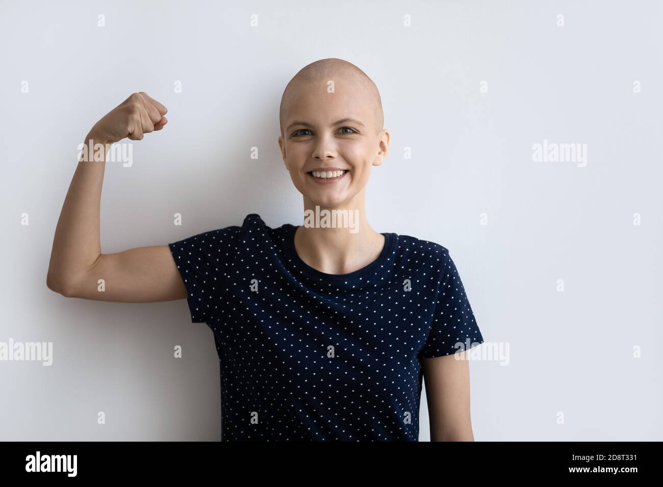 Nahaufnahme lächelnde haarlose Frau zeigt Stärke, kämpft mit Krebs Stockfoto