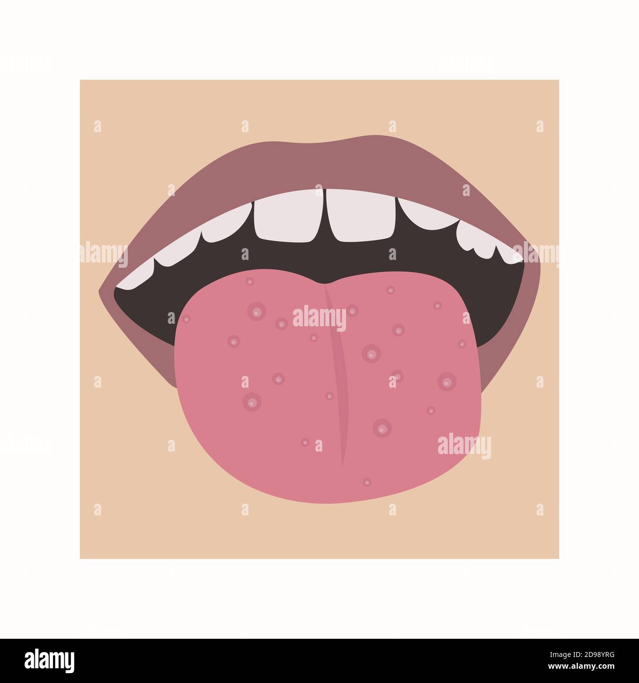 Pilz oder Akne auf der Zunge. Vektor des Mundes eines Kindes mit einer Krankheit. Stock Vektor
