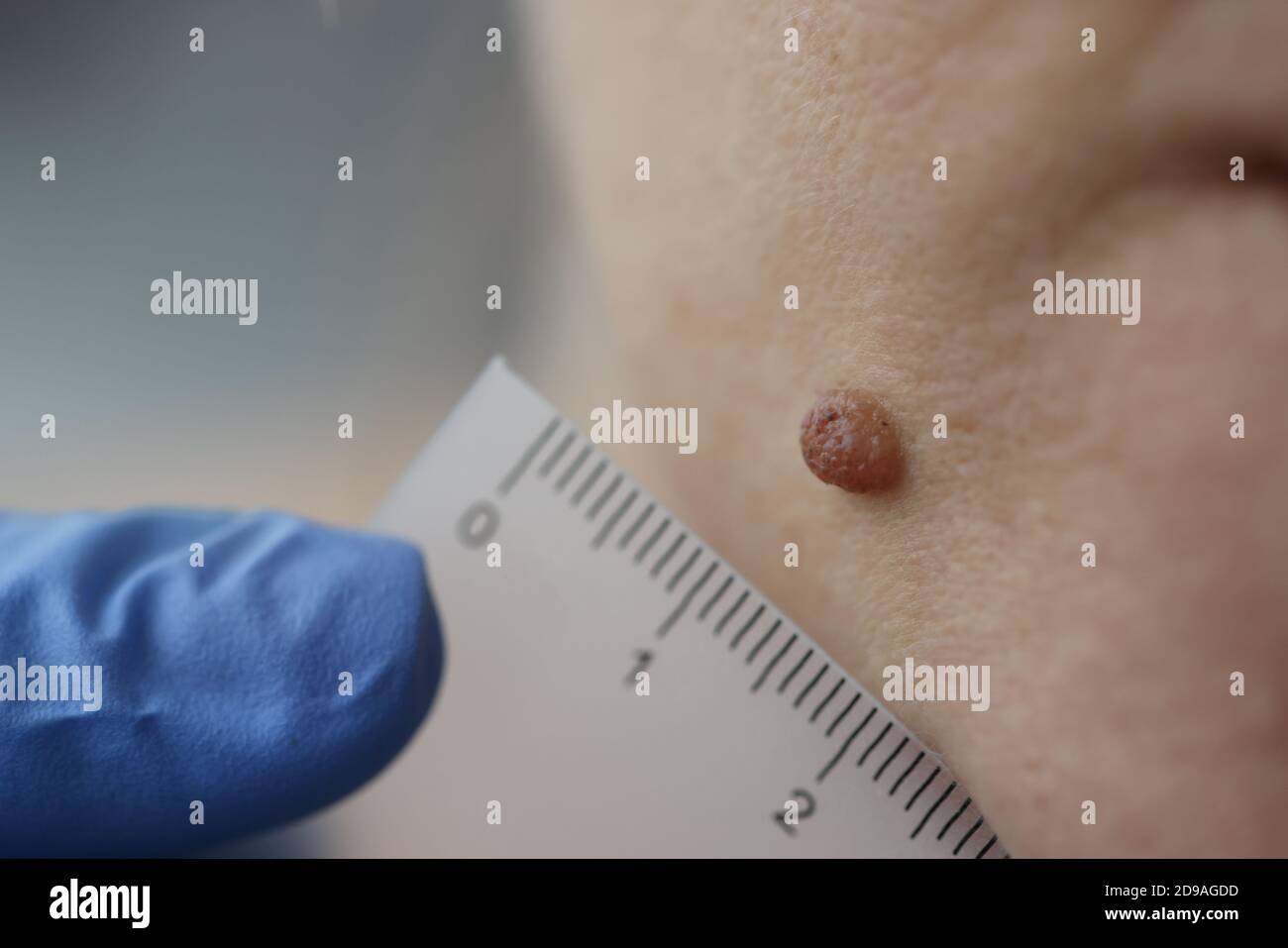 Arzt Dermatologe Messung pigmentierten Nevus auf dem Gesicht des Patienten mit Lineal In der Klinik Nahaufnahme Stockfoto