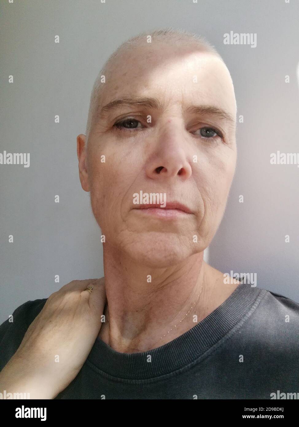 Porträt einer Glatze mit Krebs in der Hand Ihr Hals Stockfoto