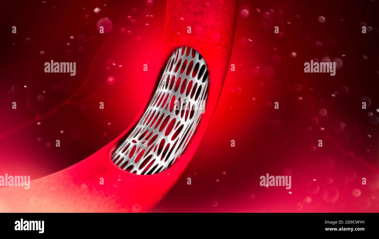 Koronarararterie-Bypass-Operation, ist ein chirurgisches Verfahren zur Wiederherstellung des normalen Blutflusses zu einer verstopften Koronararterie. Angioplastie. Cholesterin Stockfoto