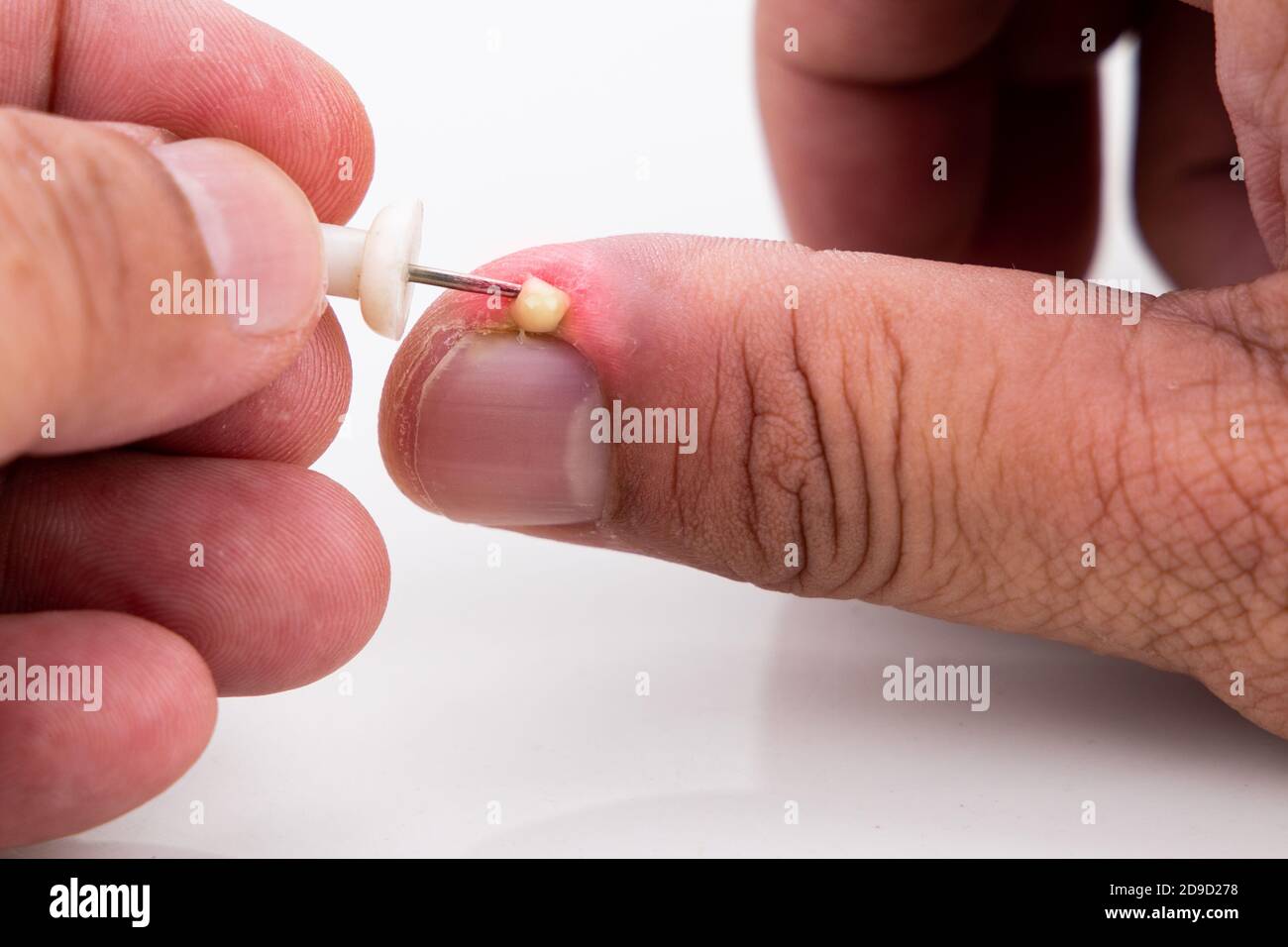 Serie von schmerzhaften Fingernagel Haut Infektion mit Eiter reatment  Stockfotografie - Alamy