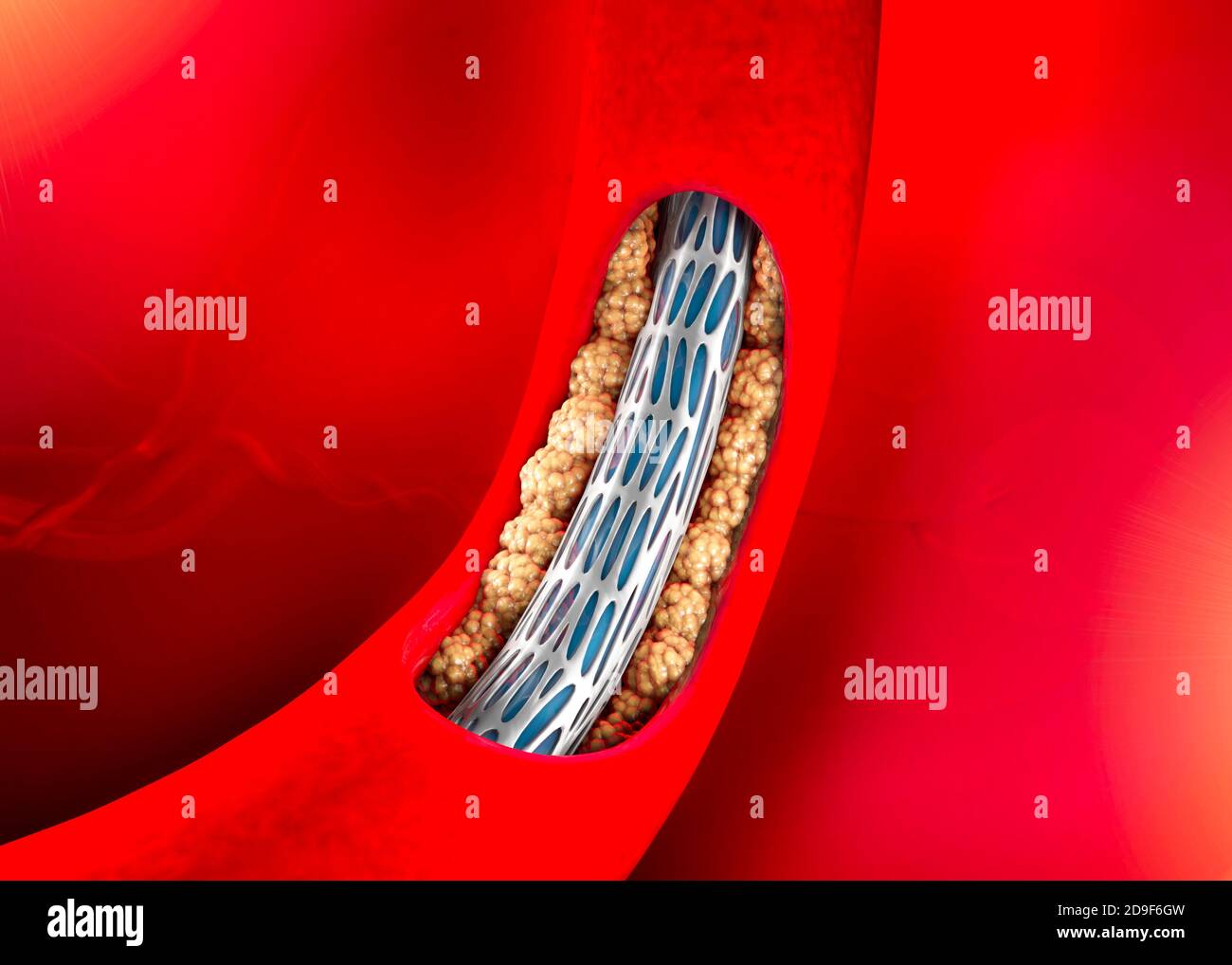 Koronarararterie-Bypass-Operation, ist ein chirurgisches Verfahren zur Wiederherstellung des normalen Blutflusses zu einer verstopften Koronararterie. Angioplastie. Cholesterin Stockfoto