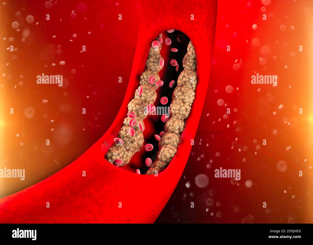 Cholesterinbildung, Fett, Arterie, Vene, Herz. Rote Blutkörperchen, Blutfluss. Verengung einer Vene für die Fettbildung. Operation, 3d-Rendering Stockfoto