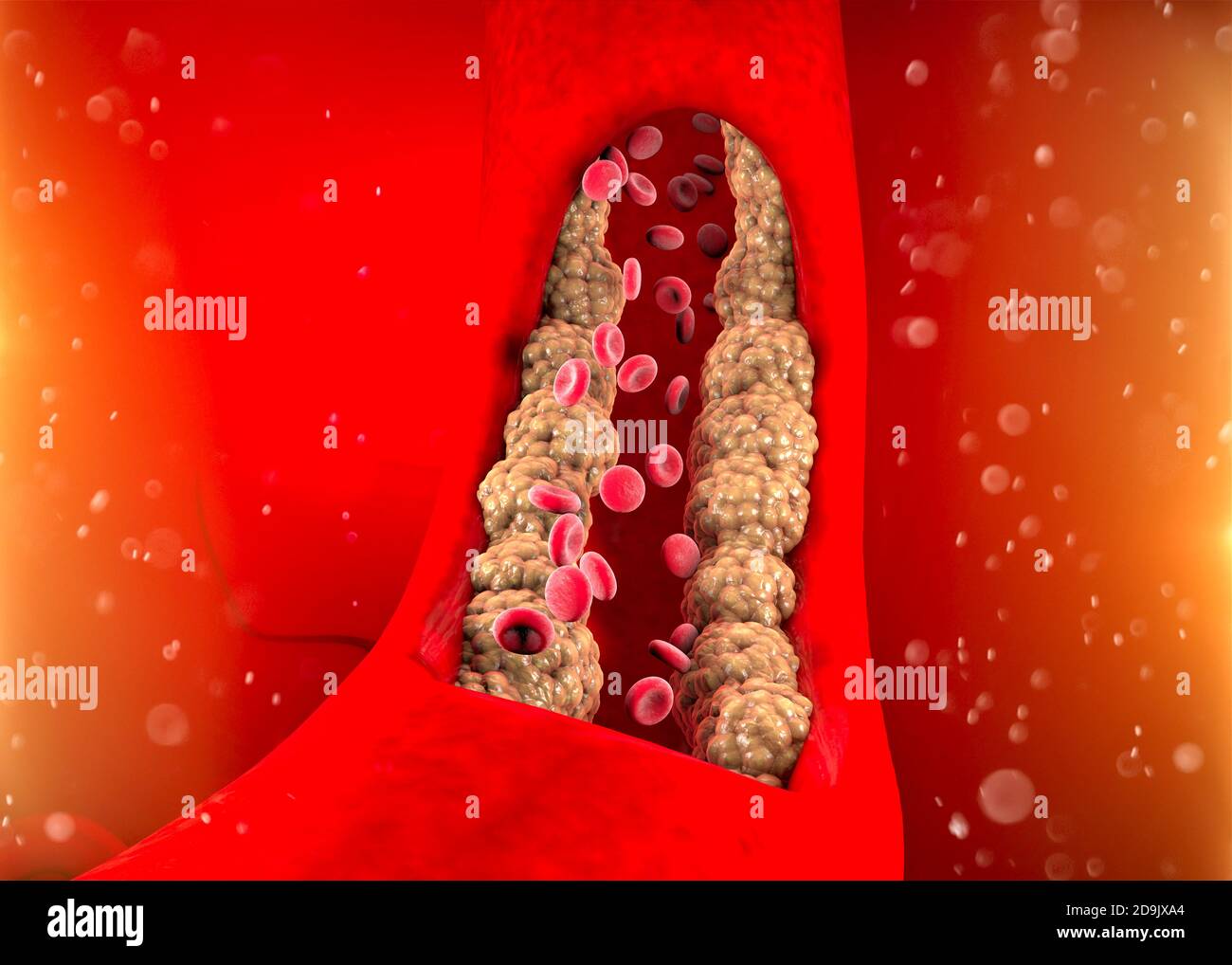 Cholesterinbildung, Fett, Arterie, Vene, Herz. Rote Blutkörperchen, Blutfluss. Verengung einer Vene für die Fettbildung. Operation, 3d-Rendering Stockfoto