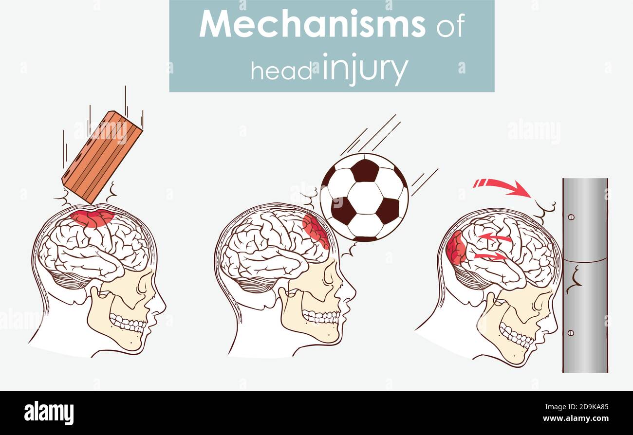 Vektordarstellung der Mechanismen der Kopfverletzung Stock Vektor