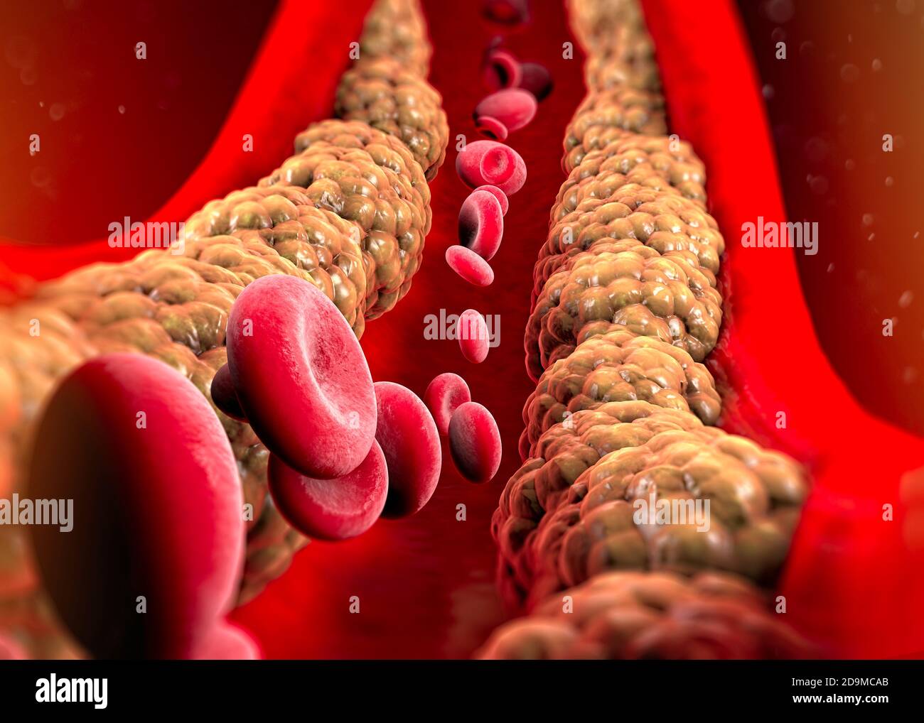 Cholesterinbildung, Fett, Arterie, Vene, Herz. Rote Blutkörperchen, Blutfluss. Verengung einer Vene für die Fettbildung. Operation, 3d-Rendering Stockfoto