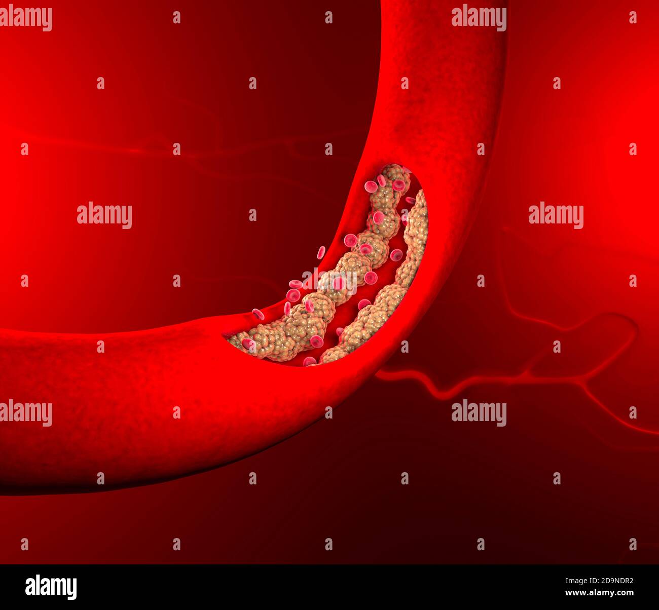 Cholesterinbildung, Fett, Arterie, Vene, Herz. Rote Blutkörperchen, Blutfluss. Verengung einer Vene für die Fettbildung. Operation, 3d-Rendering Stockfoto
