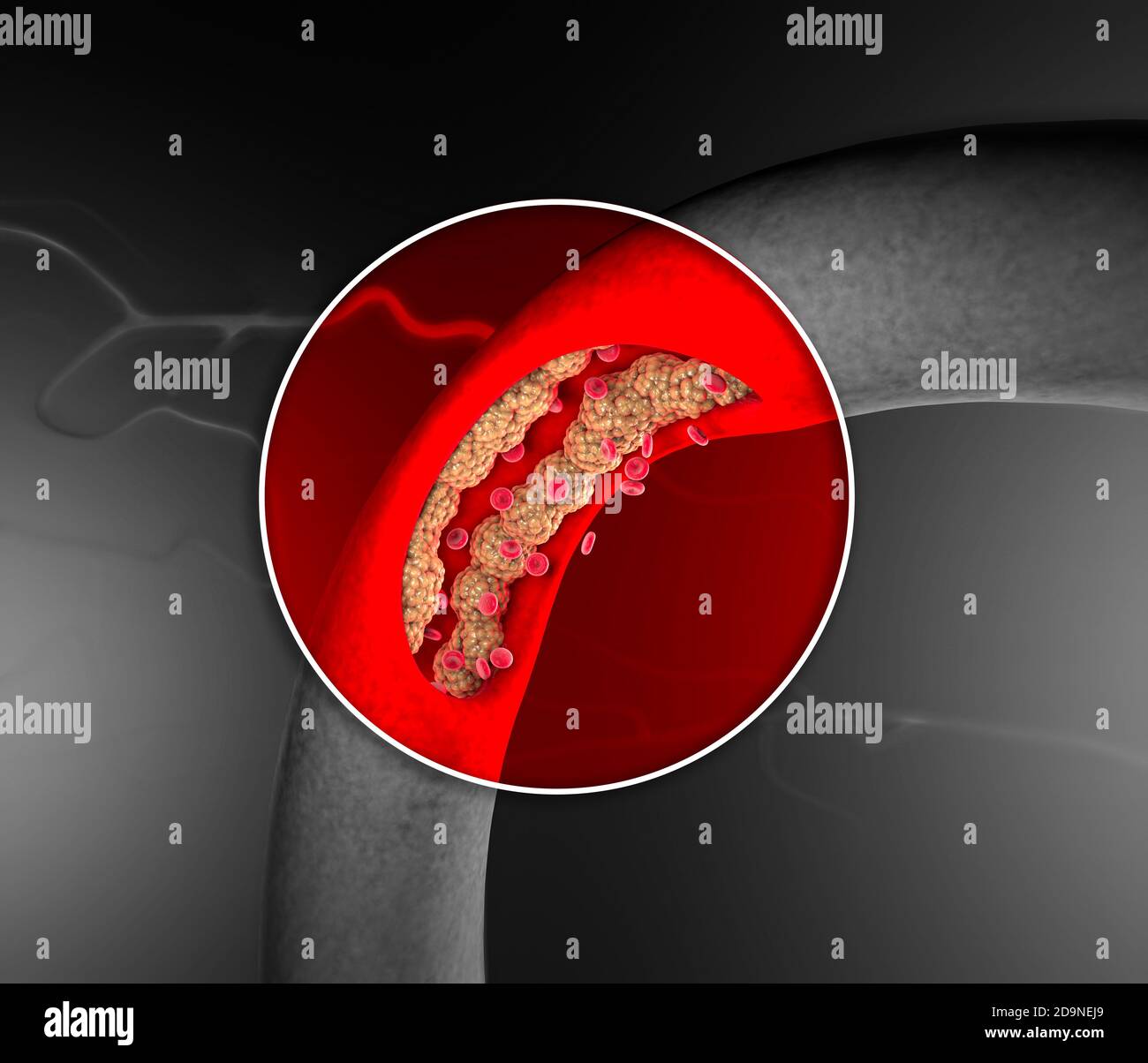 Cholesterinbildung, Fett, Arterie, Vene, Herz. Rote Blutkörperchen, Blutfluss. Verengung einer Vene für die Fettbildung. Operation, 3d-Rendering Stockfoto