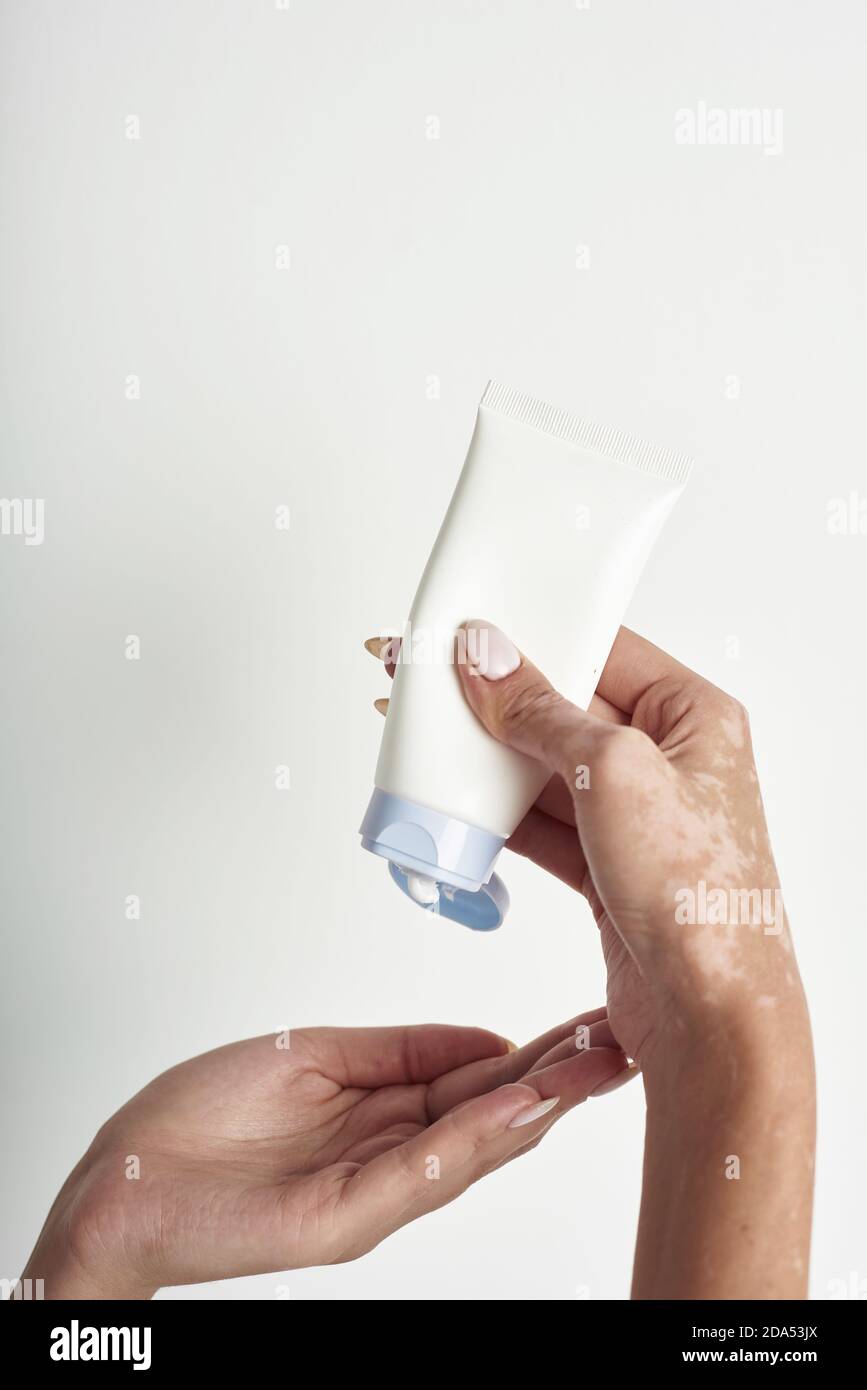 Frau Gießen Körperpflege Creme aus der Flasche in ihre Hand mit Vitiligo.  Achten Sie auf Ihre Körperhaut. Gesundheit und Schönheit Konzept  Stockfotografie - Alamy