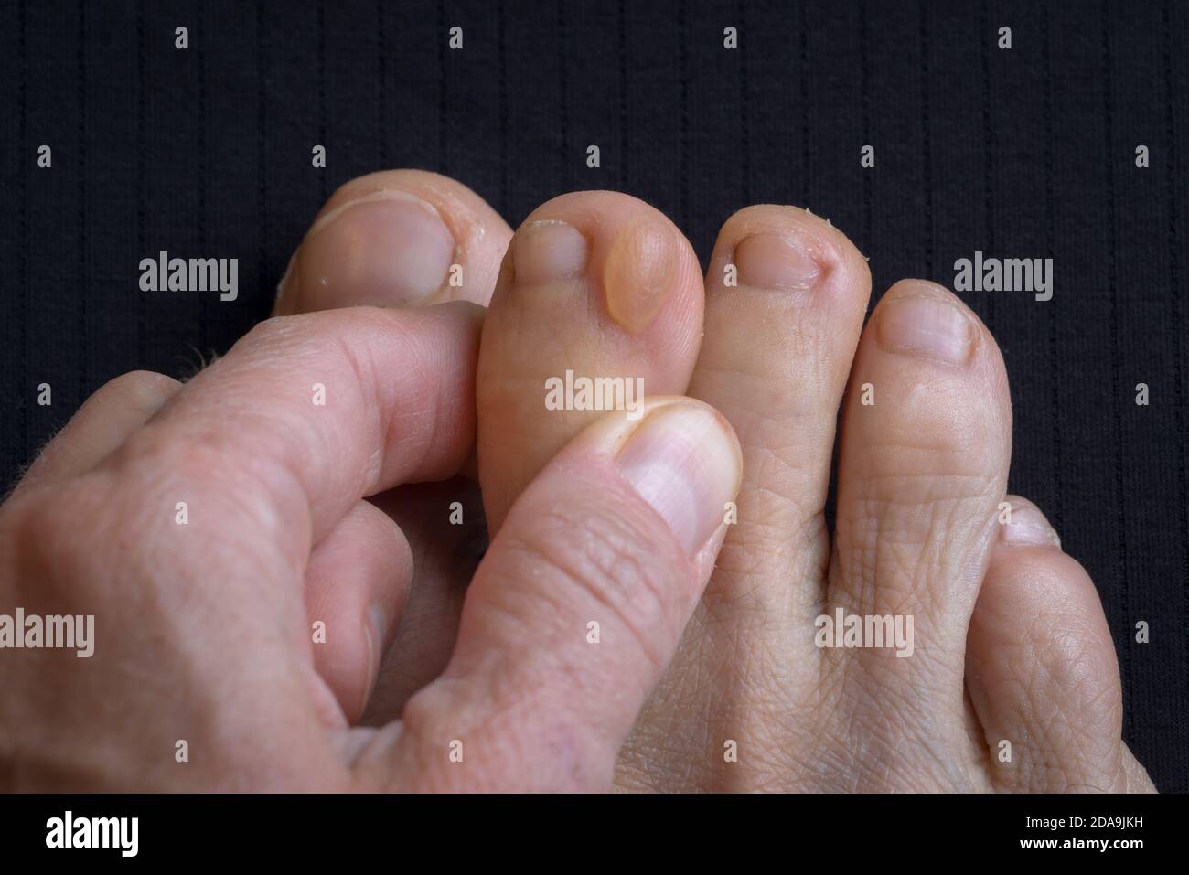 Großer Callus auf dem schmutzigen Fuß einer Frau, Nahaufnahme Foto von Callus, Füße Oberflächenverletzung Stockfoto