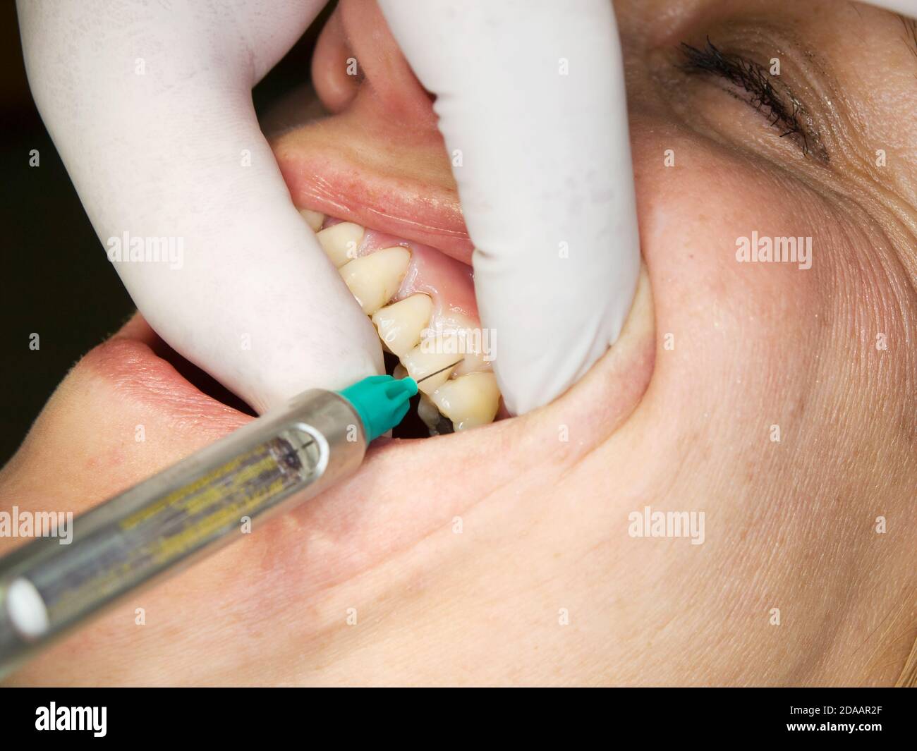 Lokale betäubung hand -Fotos und -Bildmaterial in hoher Auflösung – Alamy