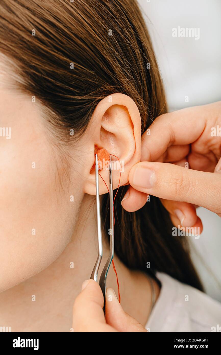 Verfahren der Herstellung von Ohrstöpseln aus dem Eindruck eines individuellen menschlichen Ohrs. Nahaufnahme des Ohrs. Persönlich geformte Ohrstöpsel. Teil des Sets Stockfoto