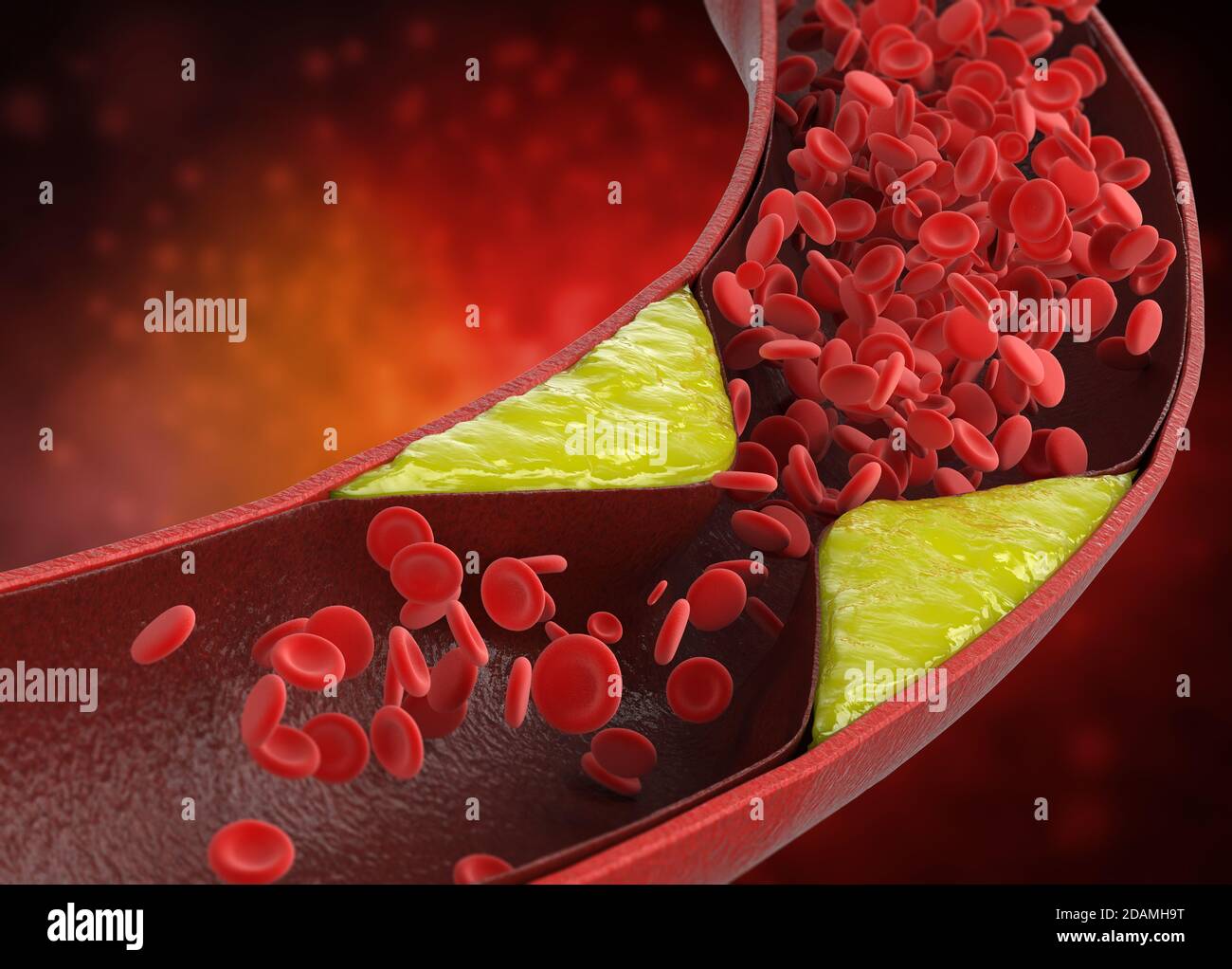 3d-Rendering Atherosklerose mit Cholesterinblut oder Plaque im Gefäß Ursache der koronaren Herzkrankheit Stockfoto