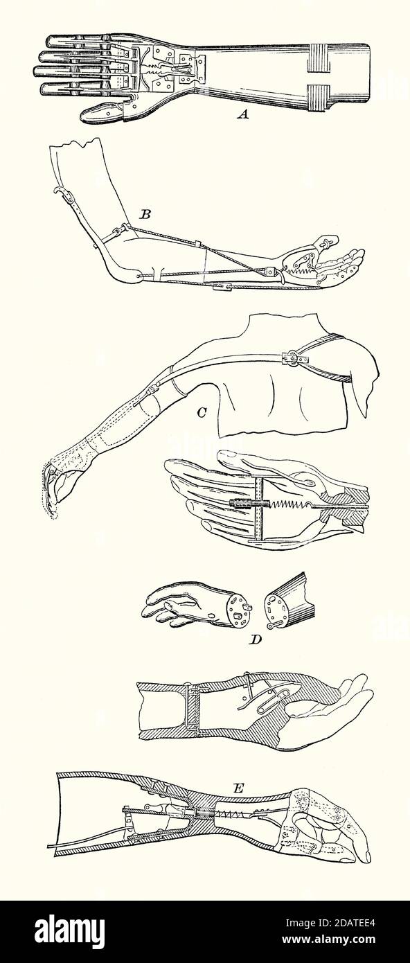 Eine alte Gravur der verschiedenen prothetischen Hände und Arme, die im 19. Jahrhundert verwendet wurden. Es ist aus einem viktorianischen Maschinenbaubuch der 1880er Jahre. Die Abbildungen zeigen die unterschiedlich gestalteten Prothetik, die zum Verklemmen, Biegen und Halten verwendet wird. Einige davon wurden von anderen Körperteilen bedient – C zeigt zwei Ansichten eines ‘Selpho’ Armes – eine von der gegenüberliegenden Schulter gesteuerte Feder ermöglicht Handbewegungen. Stockfoto