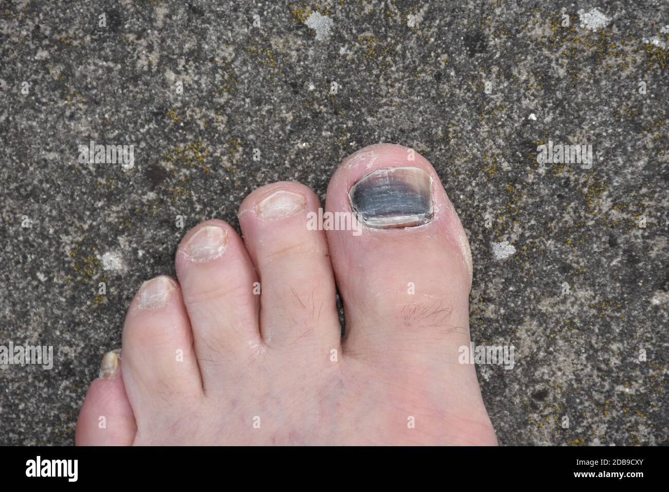 umfassend Klasse hundert zehennagel blau Zeichen Shake Zivilisieren