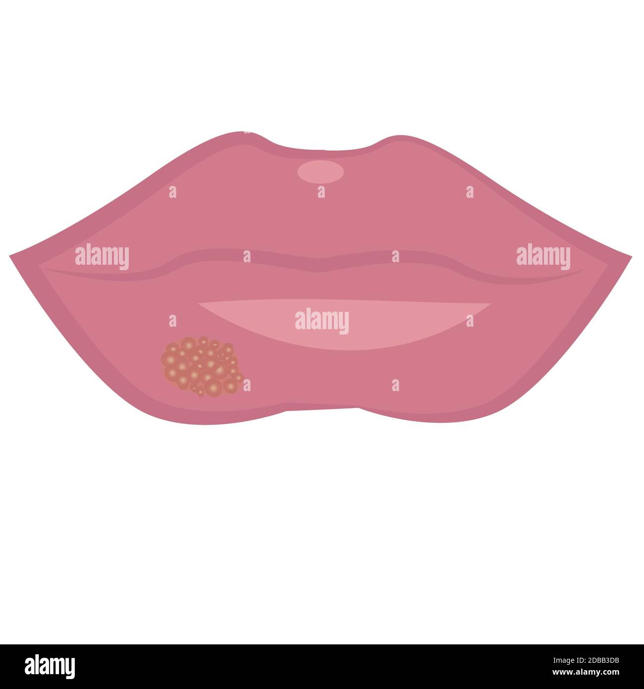 Herpes, Fieberbläschen an den Lippen Vector Illustration auf weißem Hintergrund Stockfoto