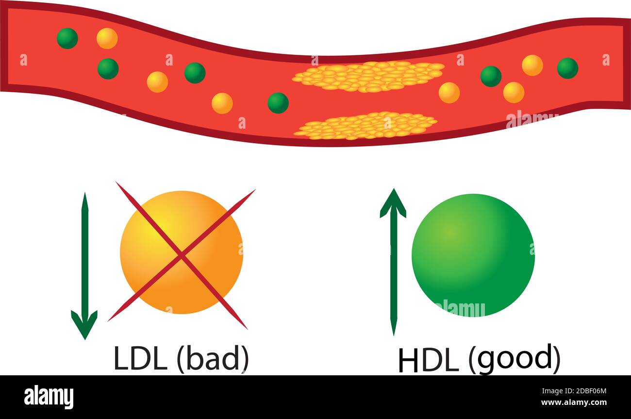 Atherosklerotische Plaque in Blutgefäßen, gute und schlechte Lipide ihre Regulation in Blutvektor Infografiken Stockfoto