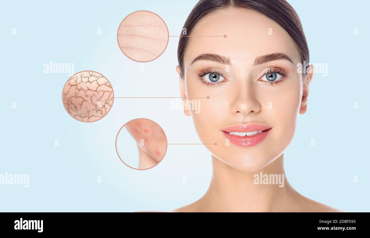 Weibliche Gesicht Nahaufnahme, zeigen Hautprobleme. Trockene Haut, Akne, Falten und andere Unvollkommenheiten. Auf blauem Hintergrund Stockfoto