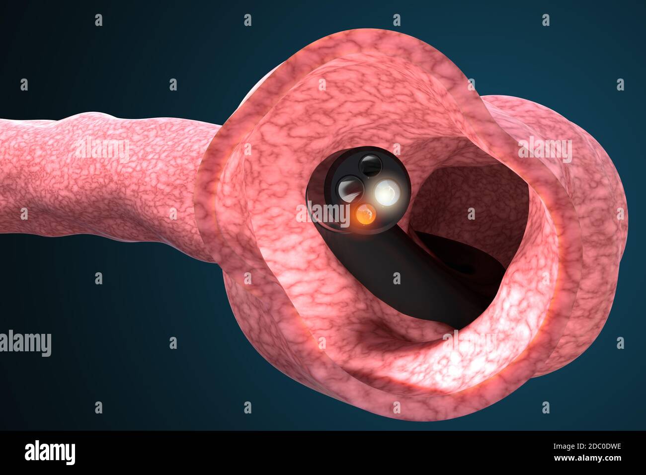 Medizinisches Gerät, um den Zustand des Darms zu überprüfen und gastrointestinale Erkrankungen zu erkennen. Koloskopie und Gastroskopie medizinische Diagnose. 3d-Illust Stockfoto